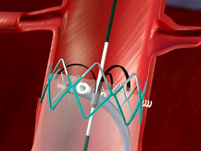 Medtronic's Heli-FX EndoAnchor system