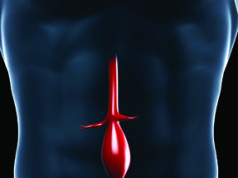 abdominal aortic aneurysm