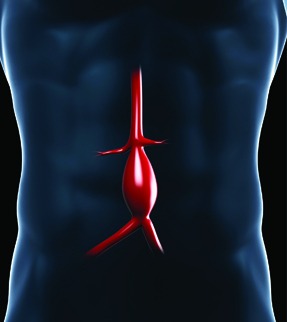 how the Abdominal aortic aneurysm works