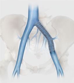 cook-medical-launches-zilver-vena-venous-self-expanding-stent-in-canada