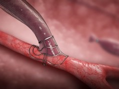 First four Spanish VasQ cases completed VasQ