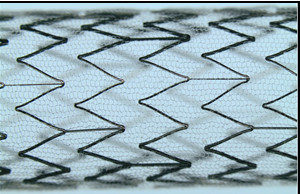 CGUARDIANS II shows positive 30-day outcomes for carotid stent use in TCAR procedures