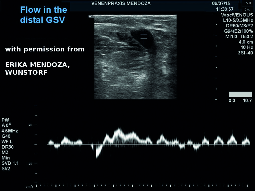 The saphenous pulse illustrated in PW (pulsed wave) mode