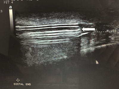 Figure 3: Ultrasound image of implant with fluid accumulating in and around the lumen