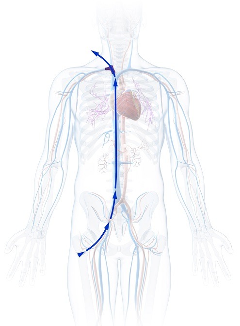 2547_Body Image Catheter Exit Graphic_04_duplicate_edited