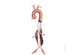 US FDA approves study of Sanford Health Unitary Manifold stent graft system