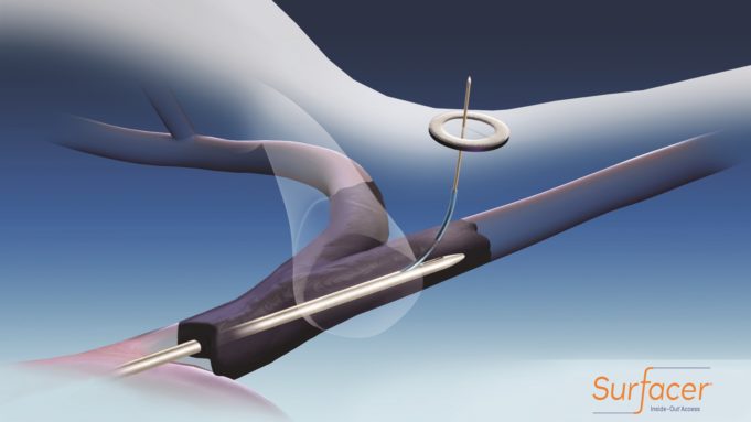 FDA grants de novo clearance to Bluegrass Vascular for Surfacer system SAVE-US trial