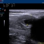 21-days-after-rivaroxaban-30mg-day-om