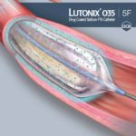 Lutonix