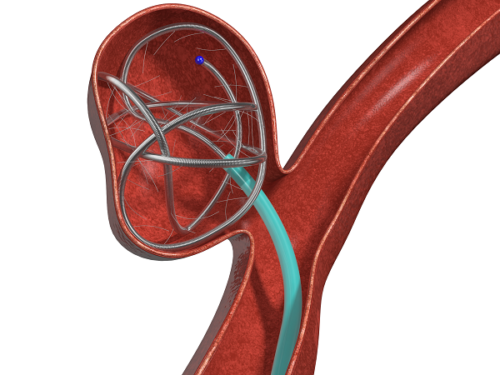 Concerto System Medtronic launches Concerto 3D detachable coil system in USA and Europe ...