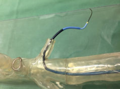 Surgical planning enhanced by 3D-printed aortic arch Stratasys 3d printed aortic arch