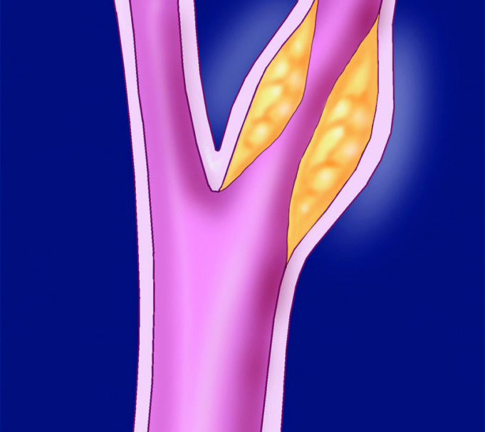 New Vascular Ultrasound Registry launched, will initially focus on carotid artery disease