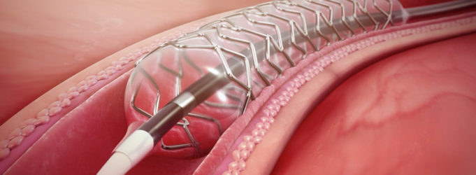 Deployable coating stents delivers drug more uniformly than traditional durable coated stents