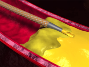Wingman catheter Reflow Medical