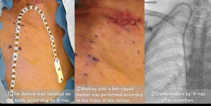 Japanese study investigates new device for accurate haemodialysis catheter placement
