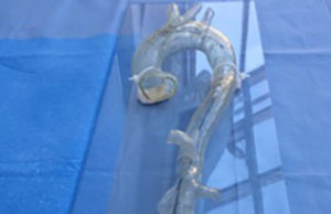 Benefits of 3D printed models in vascular surgery for planning, training and patient education