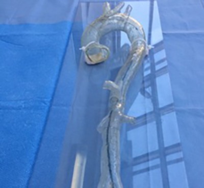 Benefits of 3D printed models in vascular surgery for planning, training and patient education
