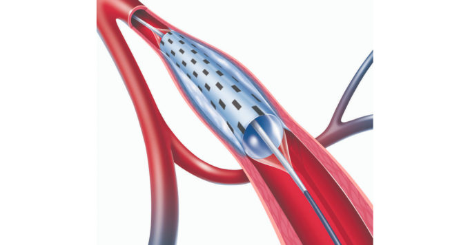 NuCryo Vascular announces commercialisation agreement with Lokai Medical