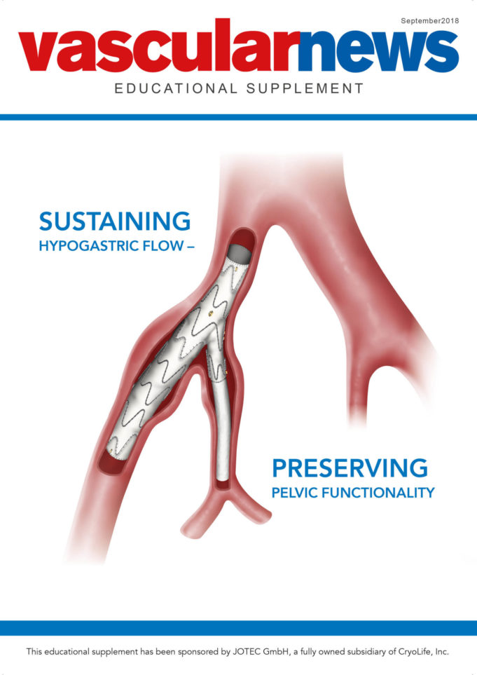E-liac stent graft: Sustaining hypogastric flow—preserving pelvic functionality