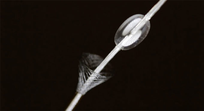 ICHOR reperfusion system receives FDA clearance