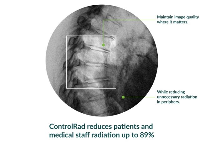 FDA clears the only radiation reduction technology that integrates into mobile C-arms ControlRad