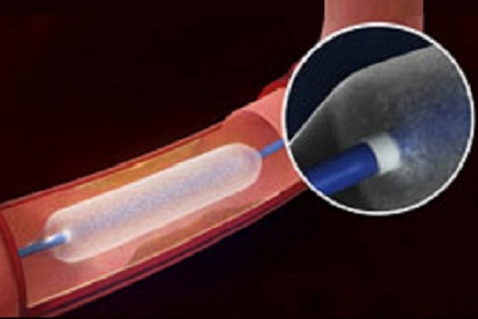 Six-month results of Lutonix AV Global registry published Lutonix