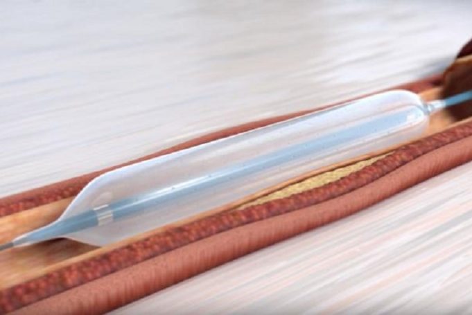 Virtue sirolimus-eluting balloon set for commercial release as Terumo and Orchestra BioMed enter global strategic partnership