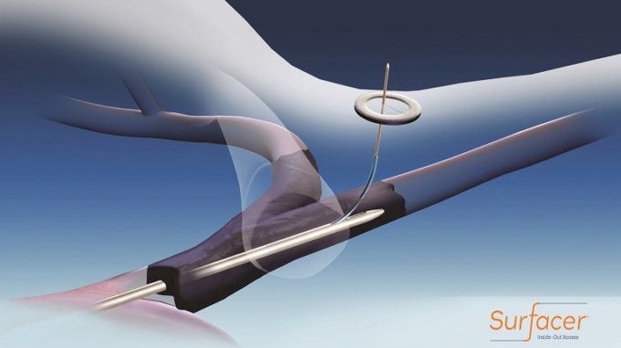 Bluegrass Vascular Technologies announces first US commercial cases with the Surfacer Inside-Out access catheter system SAVE-US