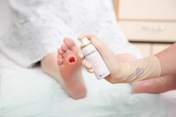 Thousands of diabetic foot ulcer patients could benefit from topical oxygen therapy with updated treatment pathway