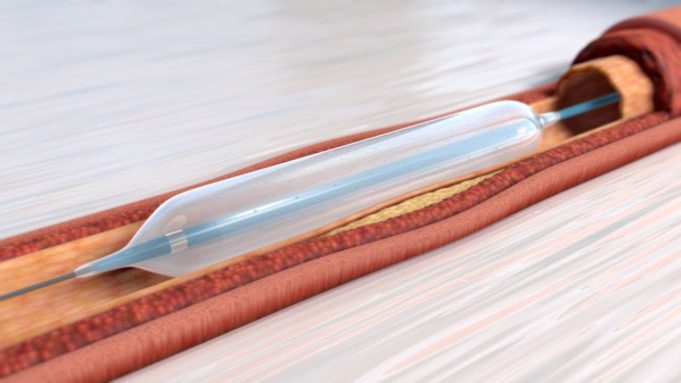 Orchestra BioMed announce FDA breakthrough device designation for Virtue sirolimus-eluting balloon virtue