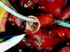 Admedus sells CardioCel and VacsuCel to focus on TAVI