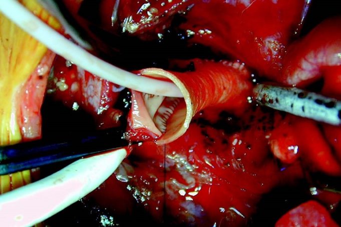 Admedus sells CardioCel and VacsuCel to focus on TAVI