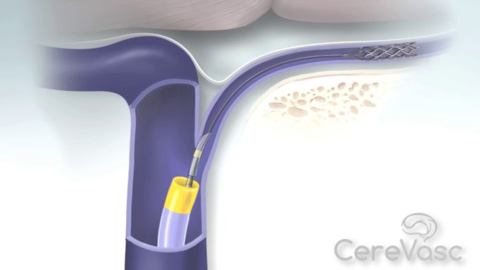 CereVasc receives approval to initiate first-in-human clinical study of the eShunt system