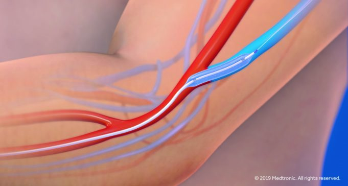 Two-year IN.PACT AV Access results presented at CX 2021 Medtronic IN.PACT AV