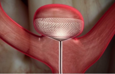 Cerus Endovascular receives CE mark approval for its Contour Neurovascular System to treat intracranial aneurysms