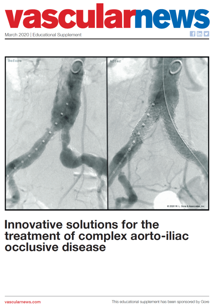 Innovative solutions for the treatment of complex aorto-iliac occlusive disease