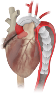 Thoraflex Hybrid Terumo Aortic