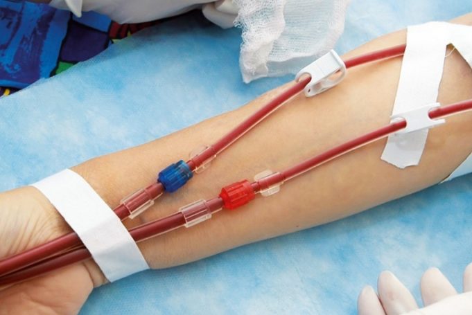 APERTO becomes the first drug-coated balloon to be approved in China for the treatment of AVF stenosis