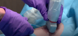 Ultrasound-guided PIV insertion