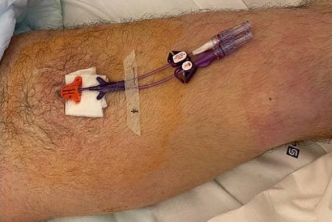 New protocol helps identify best venipuncture site for femoral access femoral