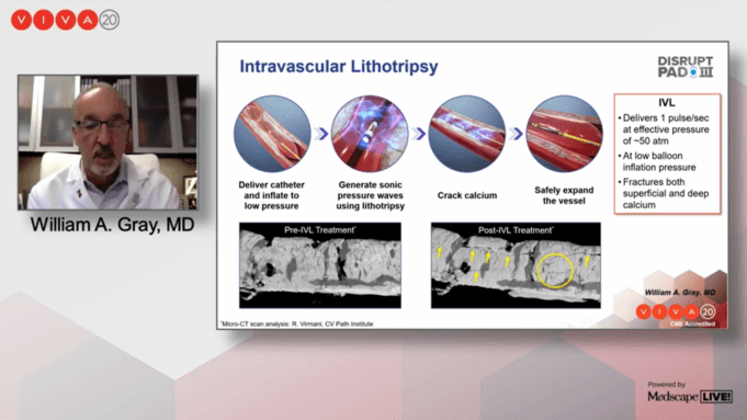 DISRUPT PAD III: Intravascular lithotripsy superior to PTA in acute procedural success out to 30 days