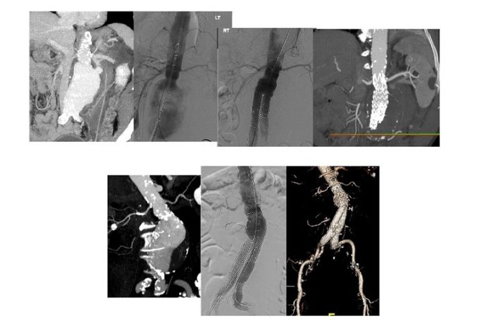 Complications of EVAR in 2020: Are they lower than they were a decade ago? EVAR