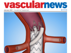 ChEVAR technique essentials: A practical guide to chimney endovascular aneurysm repair