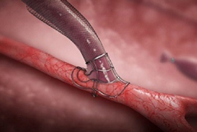 VasQ external support comparative US study results presented at VASA 2022 VasQ