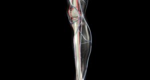 stenting