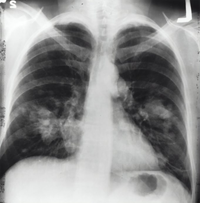 Study shows that dual screening for lung cancer and AAA could save lives