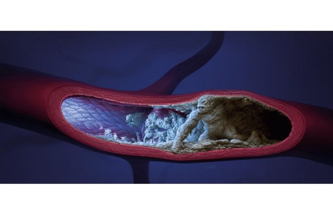 “A new look at laser”: Positive initial data presented at ISET for the Auryon atherectomy system auryon