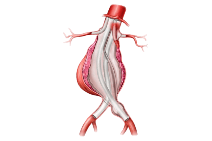 Endologix receives FDA Breakthrough Device designation for ChEVAS system