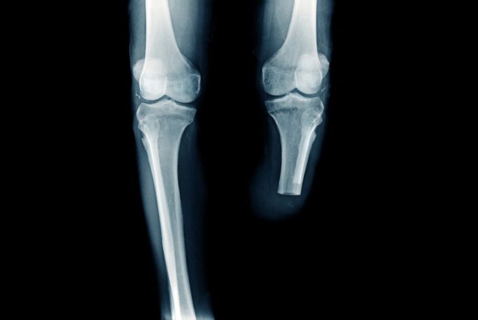 Latest meta-analysis on paclitaxel in peripheral arterial disease provokes mixed reception