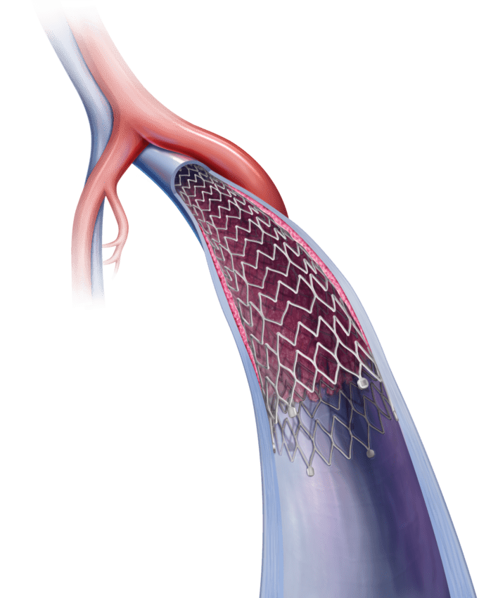 Case report: Recanalisation of chronic iliofemoral venous occlusion in a patient with PAD and saphenous reflux